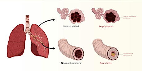 COPD/Asthma and Spirometry primary image