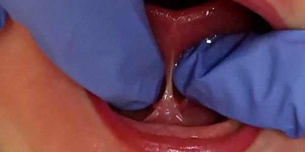 TOTS: Tethered Oral Tissues Specialty Training Phoenix, AZ Apr. 16-17, 2021
