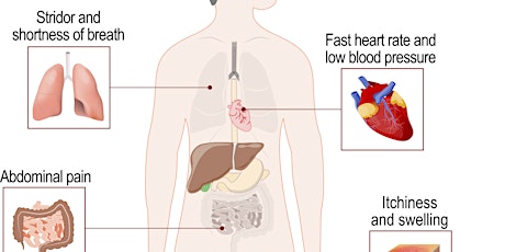 Anaphylaxis primary image