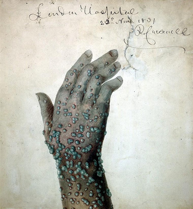 Image principale de WALKING TOUR Smallpox in Early Boston: To Vax or Not To Vax