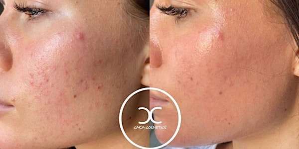 Microneedling Schulung