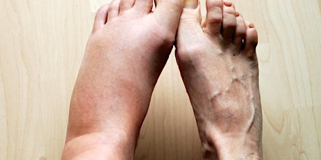 CHRONIC OEDEMA with Rachael Sykes primary image