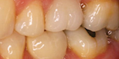 Single Tooth Implant Surgery and Restoration- 3 Locations