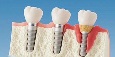 Management of Peri-Implant Infections - David Ko, Periodontist primary image