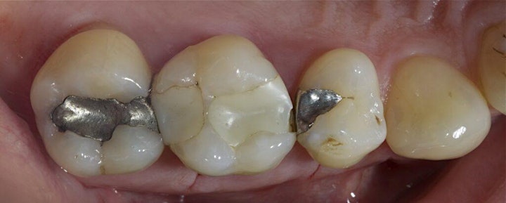 
		Parameters for choosing the correct restorations for your patients. image
