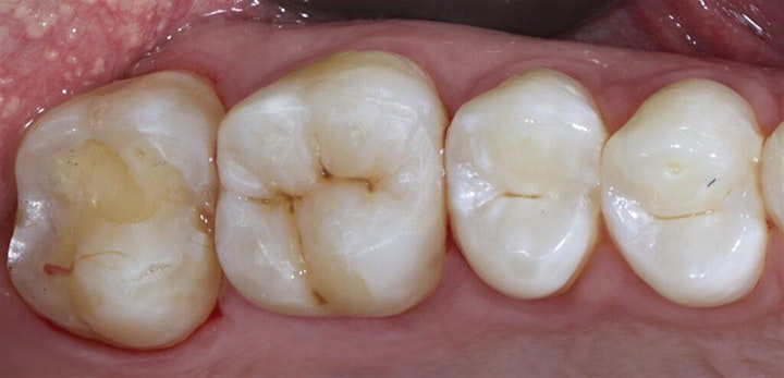 
		Parameters for choosing the correct restorations for your patients. image
