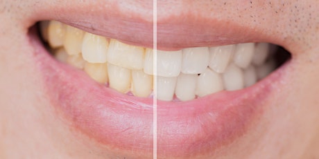 Tooth Whitening by Dental Hygienists and Therapists FREE ONLINE WEBINAR