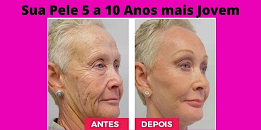Ácido hialurônico em São José do Rio Preto Sua pele 5 a 10 anos mais Jovem  primärbild
