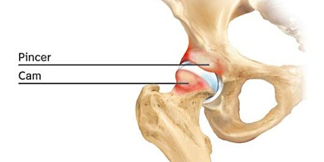 Femoro-acetabular impingement and Knee ligament injuries primary image