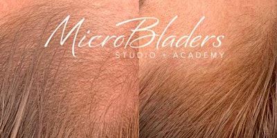 MicroBladers’ Las Vegas Machine Hairline Restoration Training Workshop