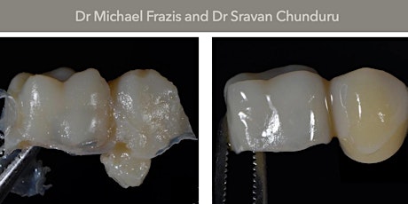 Non-Implant replacement options for single missing teeth 2022 tickets