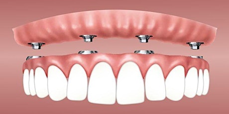 All-on-Four Dental Implant Maintenance