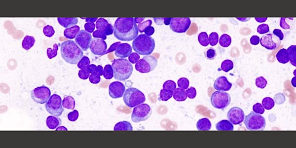 Decoding Cancer. New Hope in Multiple Myeloma Treatment.