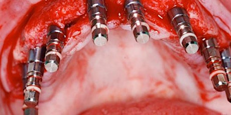 Oral rehabilitation, dental implant/pre-implant surgery: Back to the future primary image