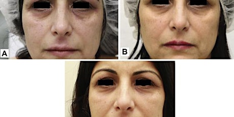 Long-term control of atopic dermatitis with platelet-rich plasma primary image
