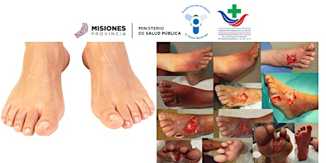 Imagen principal de I Jornada Provincial de Pie Diabético y Ulceras en Miembros Inferiores