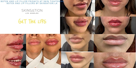 Lip Filler and Botox Friday's at our Medical spa in Los Angeles, California