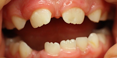 Hypodontia - the Orthodontic / Restorative interface primary image
