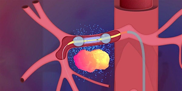 Localized Intra-arterial Drug Delivery for the Treatment of Solid Tumors