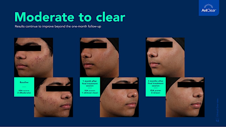 AviClear Acne Event image
