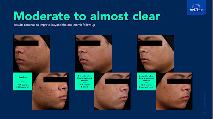 AviClear Acne Event image