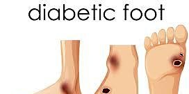 Diabetic Foot and its' complications  (UK Healthcare Professionals only)