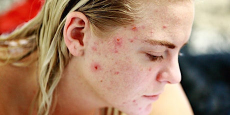 Ebook Todo sobre el acné. Piel, emociones y estilo de vida