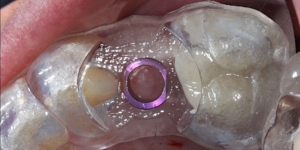 3D Implant Plan & Place