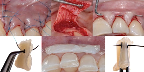 Periodontal Plastic Surgery Course [Sydney ] - Dr Olivier Carcuac