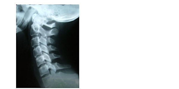 Understanding Strangulation and Its Impact on Survivors (Lanham)