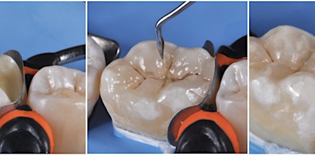 Mastering Direct Posterior Restorations with Dr. Mehrdad Razaghy