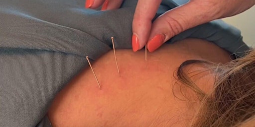 Dry Needling in a Clinical Setting