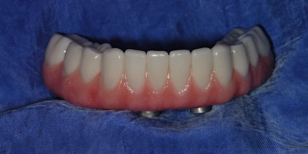 New Course: Immediate Full Arch Implant Reconstruction