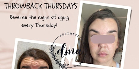 Throwback Thursdays - Reverse the signs of aging with Botox