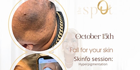 Fall in Love with Your Skin:  Treating Hyperpigmentation primary image