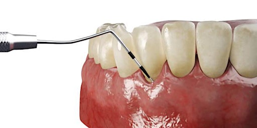 Periodontal Maintenance on the Implant Patient