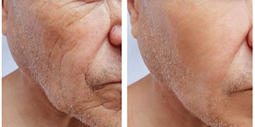 Collagen Boosting Biostimulators for Facial Contouring - Orlando, FL primary image
