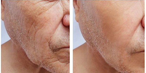 Collagen Boosting Biostimulators for Facial Contouring - Orlando, FL