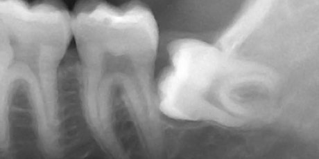 “3rd Molars – risk assessment and planning: to extract or not?” AND “Patient safety & Wrong site surgery” primary image