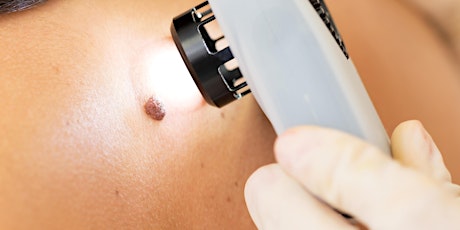Protect yourself against skin cancer, moles and benign skin lesions. (The Bristol Health & Well-being Fair)  primary image