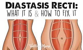 Intro to Diastisis Recti Resolution and Pelvic Floor Strengthening