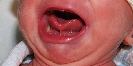 Impact of Tongue Tie on Breastfeeding w. Dr. Ghaheri primary image