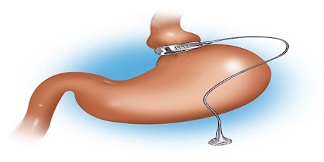Image principale de Curso Nutrición en Cirugía Bariátrica y Metabólica.