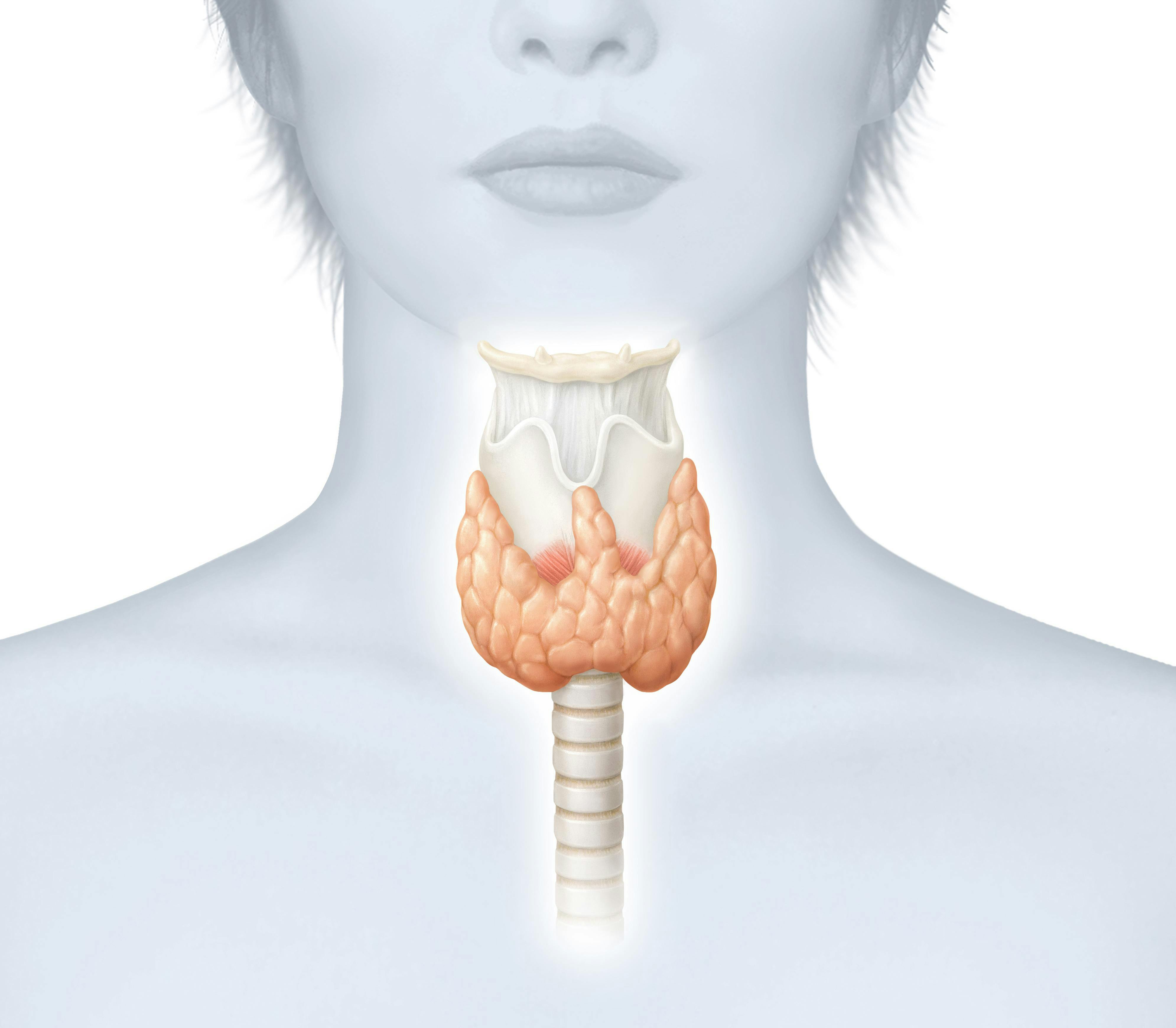 Щитовидная восстановилась. Эндемический зоб щитовидной железы. Диффузный эндемический зоб. Щитовидная железа болезнь Хашимото.