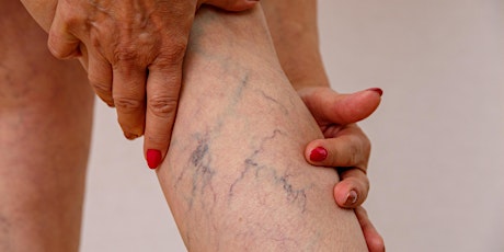 Free Varicose Vein Mini Consultation with Mr Michael Guest primary image