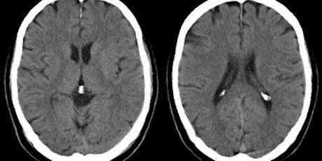 Neuro Imaging Night: A Simple Approach to Head CT primary image