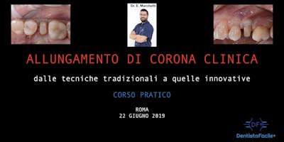 Allungamento corona clinica - Corso Pratico Allungamento corona clinica - Corso Pratico