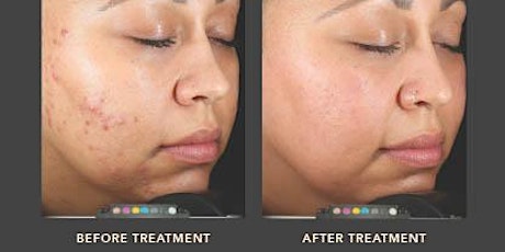 Open House for Acne Laser Treatment