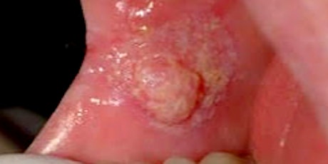 Oral Malignancies and Mimics