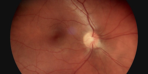 OCT Interpretation for Optoms, Ophthalmology Lecture primary image